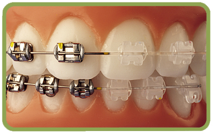 Comparação entre Brackets Cerâmicos e Metalicos